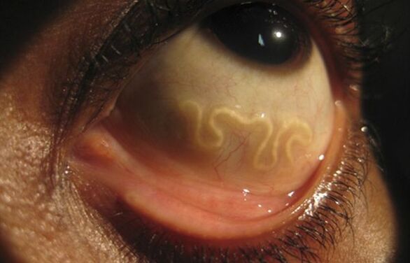 Il verme Loa Loa vive nell'occhio umano e provoca la cecità